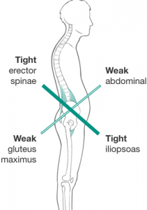 lower cross syndrome illustration