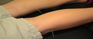 acupuncture needles in leg