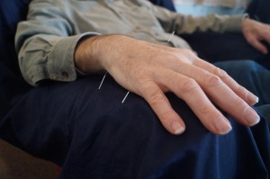 Closeup image of older man's hand with acupuncture needles in it