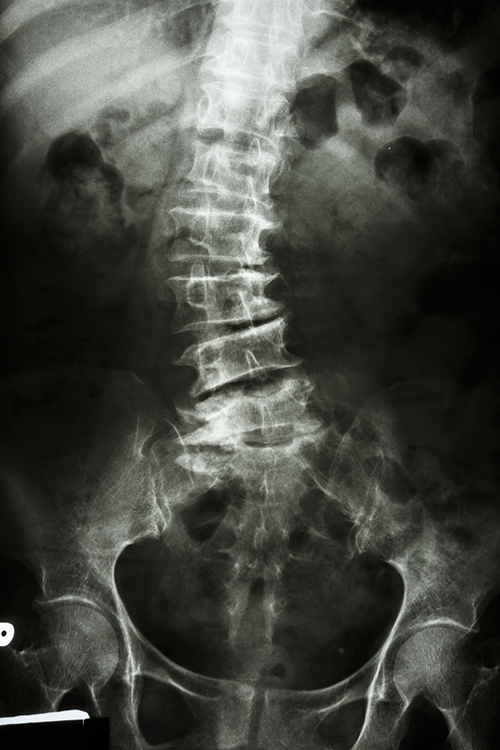 Scoliosis x-ray film