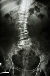 Scoliosis x-ray