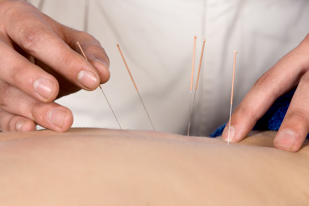 Physiotherapist doing accupuncture